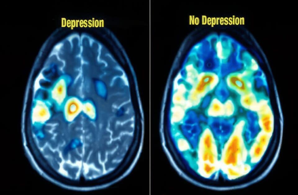 Depression Sucks: 16 Coping Strategies When Life Gets Rough 3 depressed vs normal brain